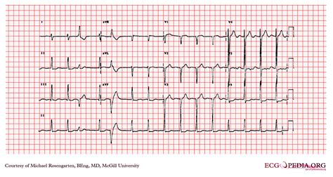 left ventricular hypertrophy ecg findings.